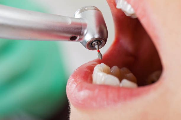 Best Emergency Dental Care for Broken or Chipped Teeth in Fair Oaks, CA